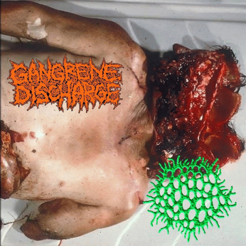 Gangrene Discharge : Gangrene Discharge - Laparoscopic Hysterectomy